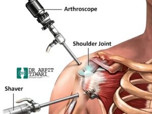 Best shoulder arthroscopy surgeon in Indore providing advanced treatment for sports injuries and shoulder